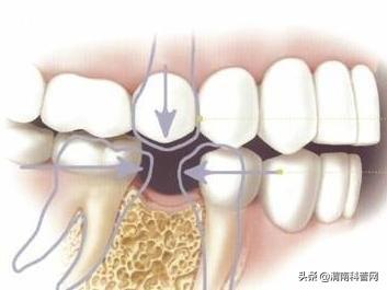 前沿科技助力，牙齿拔除术革新突破——揭秘最新拔牙技术